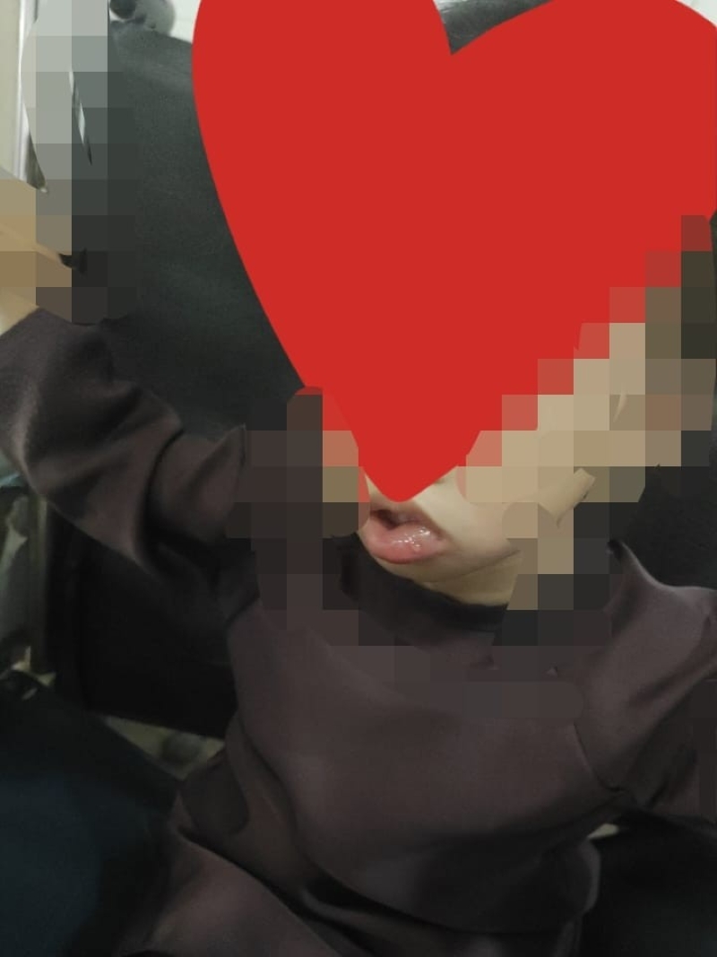 Bibir Bengkak Balita di Sukabumi Indah Dipastikan Akibat Alergi, Bukan Makanan PMT Basi