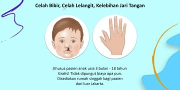Bantu Anak Kurang Mampu, RS Islam Jakarta Cempaka Putih Fasilitasi Operasi Polidaktili Gratis